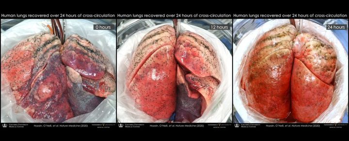 Attaching damage Human Lungs to Pigs Can Be Repair them